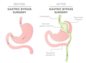 Gastric Bypass Surgery Sydney