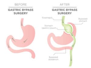 Gastric Bypass Surgery Sydney