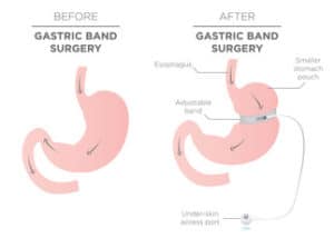 Gastric band surgery