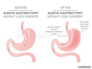 Gastric Sleeve Surgery