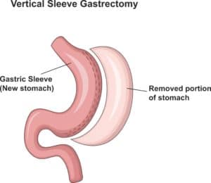 Gastric Sleeve Surgery Sydney