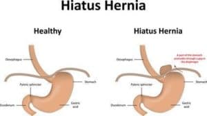 Hernia Operation Sydney