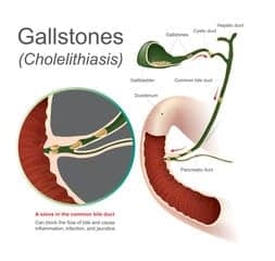 gallstone removal