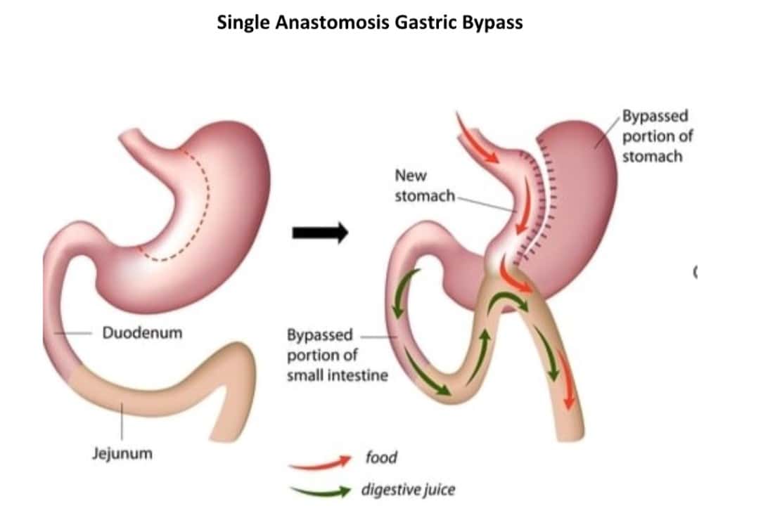 Single Anastomosis Gastric Bypass